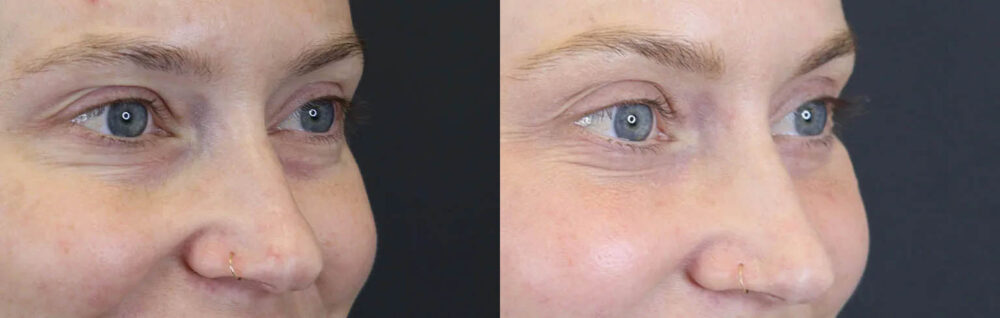 Blepharoplasty case #8411