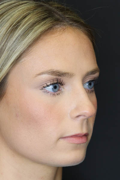 Rhinoplasty case #8344