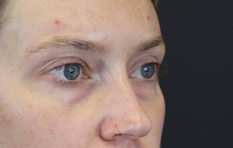 Blepharoplasty case #8411