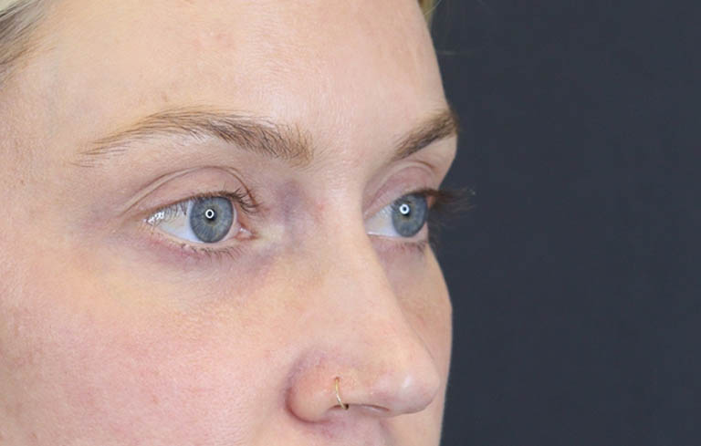 Blepharoplasty case #8411