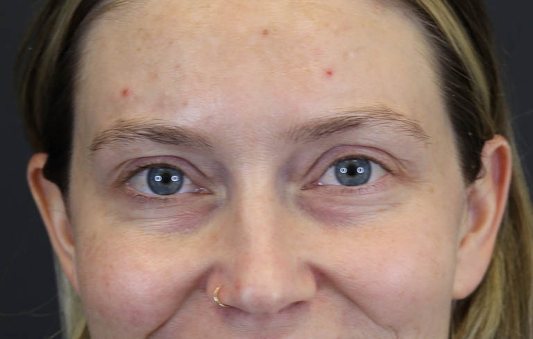 Blepharoplasty case #8411