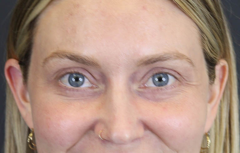 Blepharoplasty case #8411