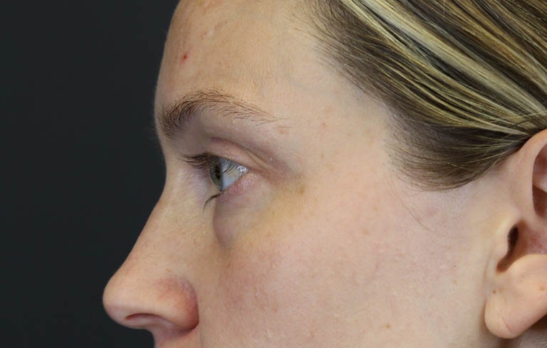 Blepharoplasty case #8411