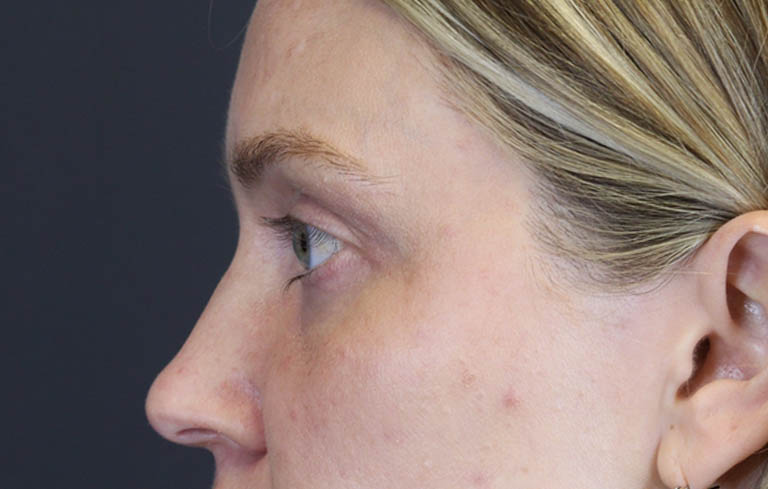 Blepharoplasty case #8411