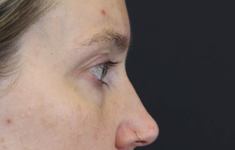Blepharoplasty case #8411
