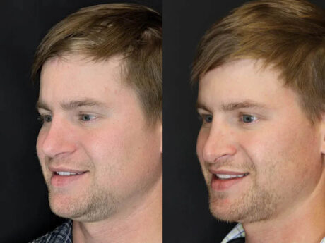 Revision Rhinoplasty case #8443