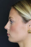 Rhinoplasty case #8344
