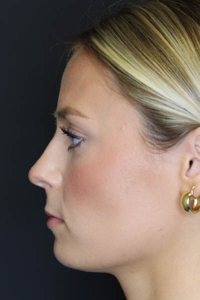 Rhinoplasty case #8344