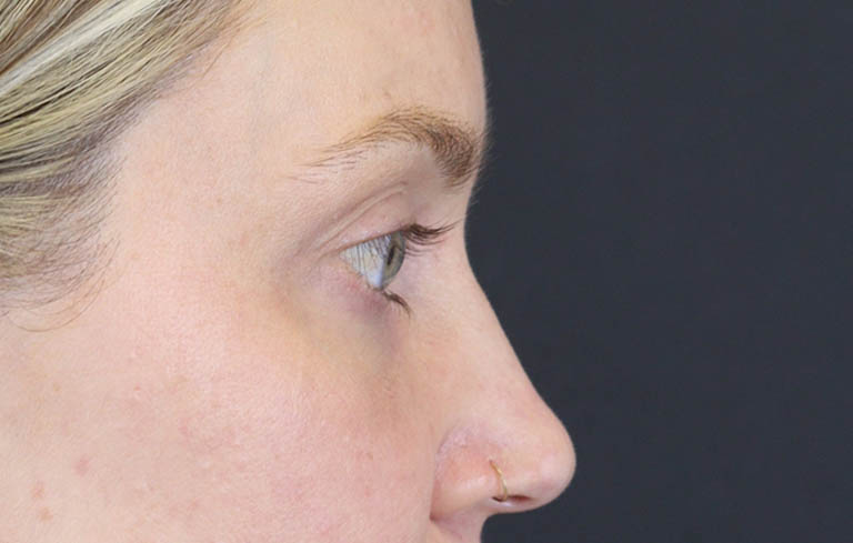 Blepharoplasty case #8411