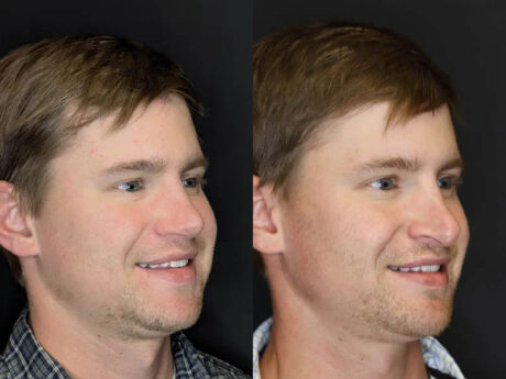 Revision Rhinoplasty case #8443