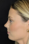 Rhinoplasty case #8344