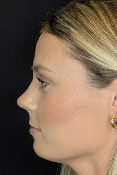 Rhinoplasty case #8344