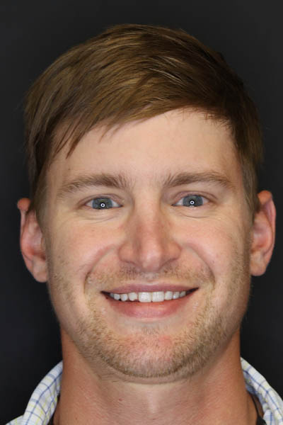 Revision Rhinoplasty case #8443