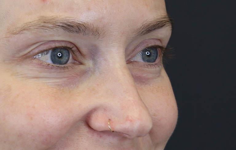 Blepharoplasty case #8411