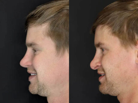 Revision Rhinoplasty case #8443