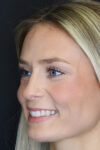 Rhinoplasty case #8344