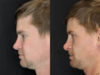 Revision Rhinoplasty case #8443 slider thumbnail