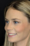 Rhinoplasty case #8344