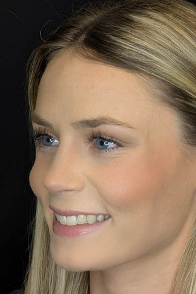 Rhinoplasty case #8344