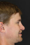 Revision Rhinoplasty case #8443