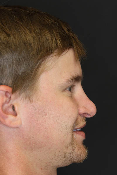 Revision Rhinoplasty case #8443