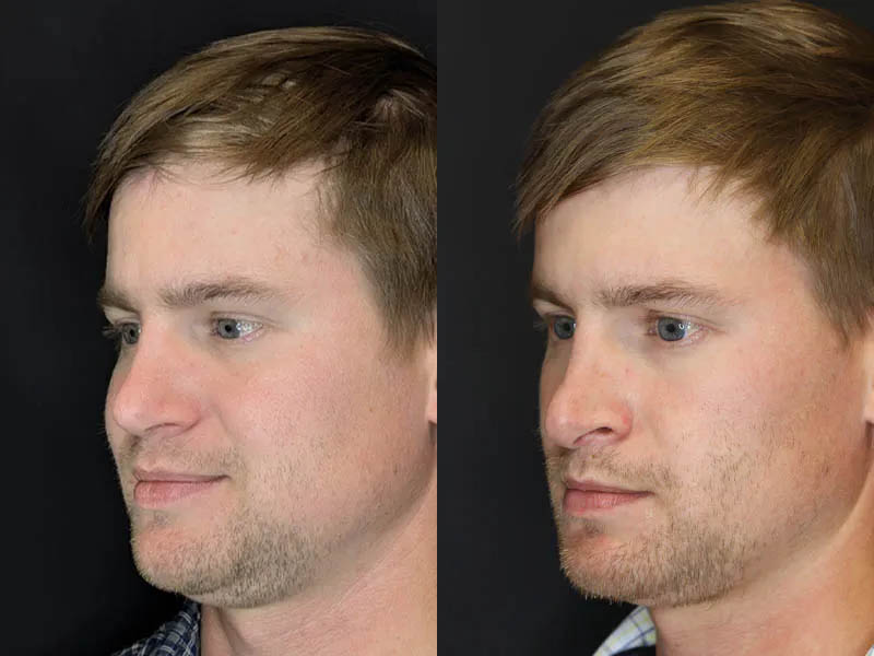 Revision Rhinoplasty case #8443