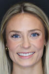 Rhinoplasty case #8344