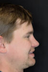Revision Rhinoplasty case #8443
