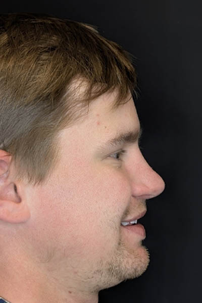 Revision Rhinoplasty case #8443