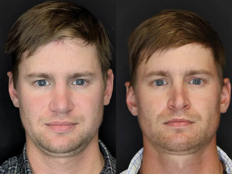 Revision Rhinoplasty case #8443