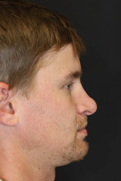 Revision Rhinoplasty case #8443