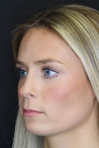 Rhinoplasty case #8344