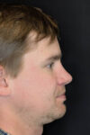 Revision Rhinoplasty case #8443