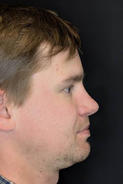 Revision Rhinoplasty case #8443