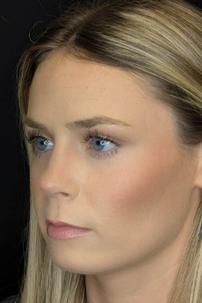 Rhinoplasty case #8344