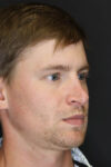 Revision Rhinoplasty case #8443
