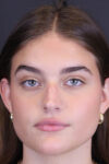 Rhinoplasty case #8366