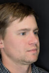 Revision Rhinoplasty case #8443