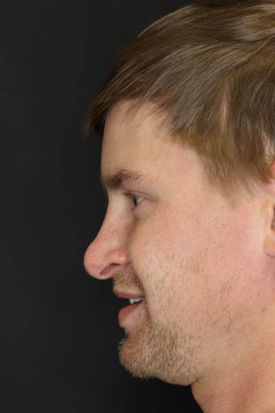 Revision Rhinoplasty case #8443