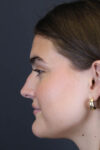 Rhinoplasty case #8366