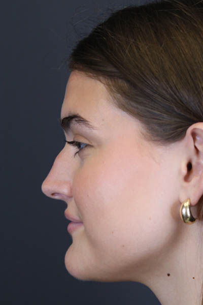 Rhinoplasty case #8366