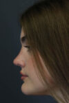 Rhinoplasty case #8366