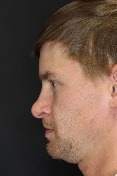 Revision Rhinoplasty case #8443