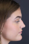 Rhinoplasty case #8366