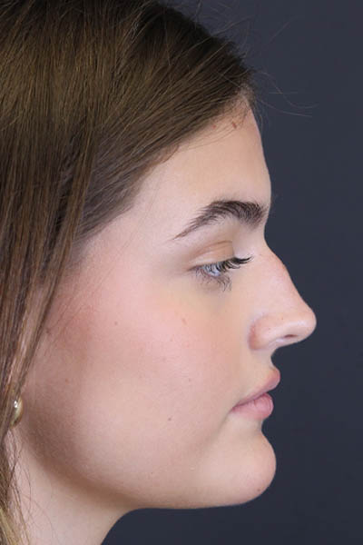Rhinoplasty case #8366