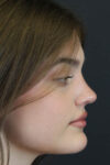 Rhinoplasty case #8366