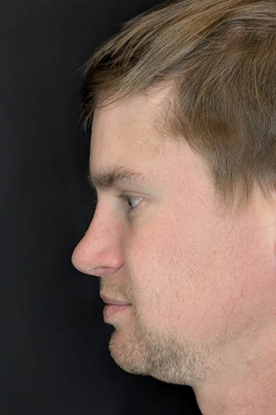 Revision Rhinoplasty case #8443