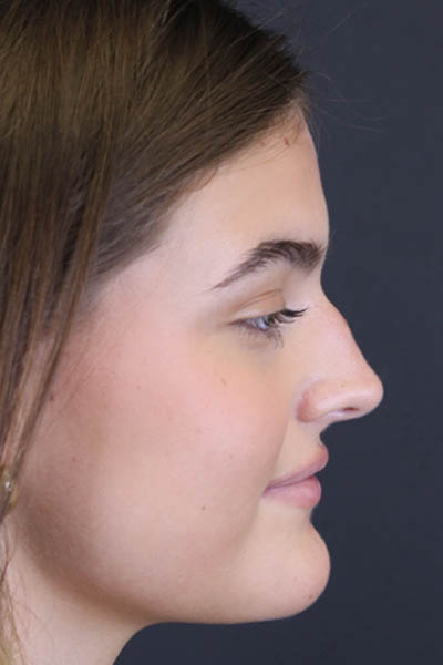Rhinoplasty case #8366