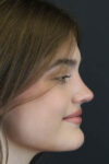 Rhinoplasty case #8366