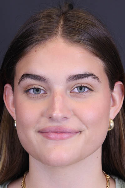 Rhinoplasty case #8366
